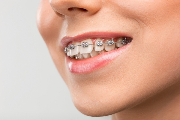 Orthodontic Treatments