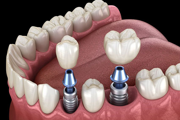 Dental Implant